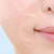 Quanis Dermafiller патчи с гиалуроновыми микроиглами